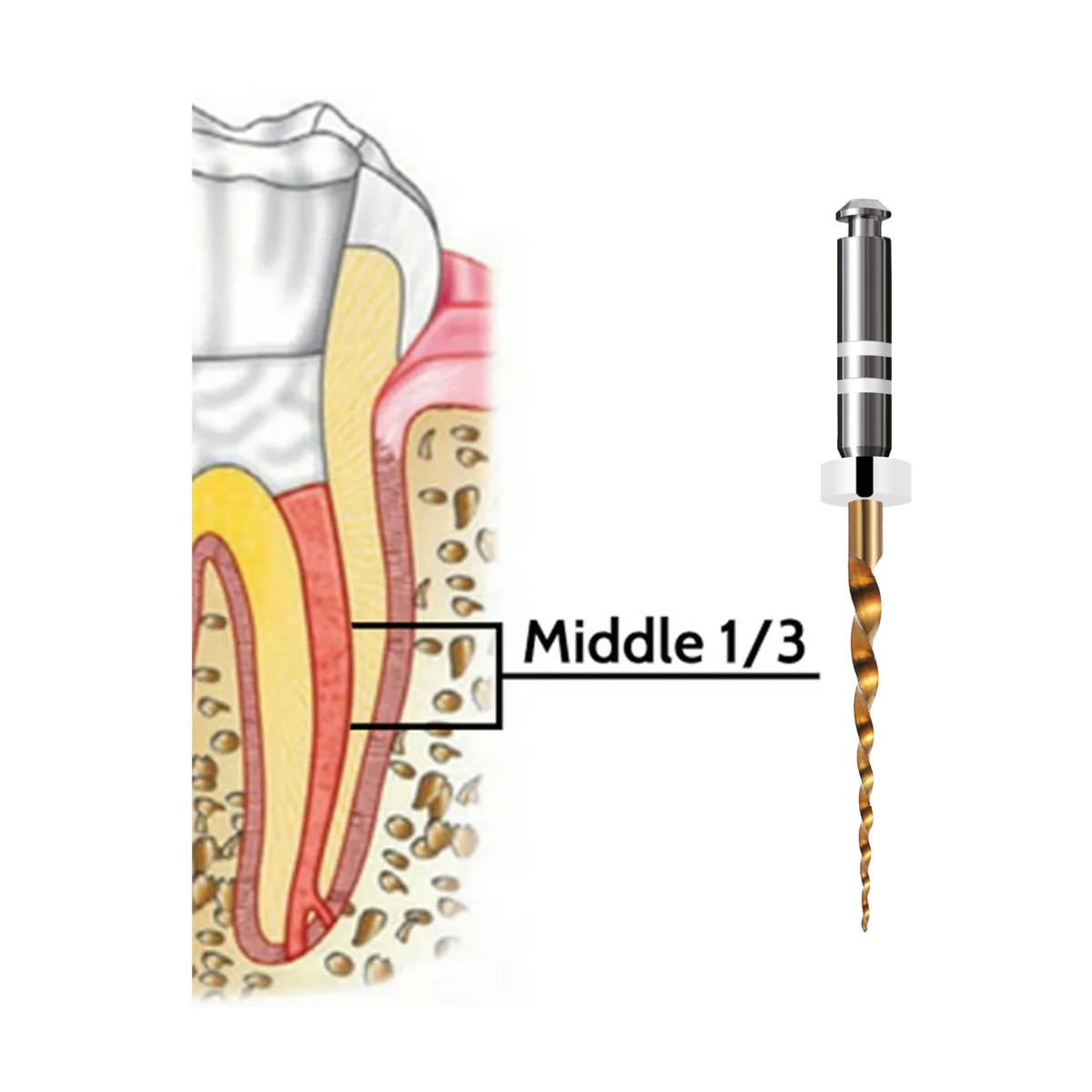 Waldent Retreatment Rotary Files