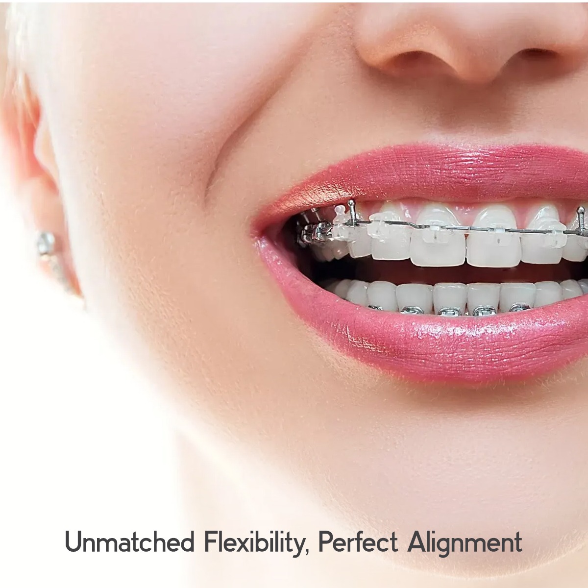 OrthoMetric Flexy NiTi Thermal 35ºC Archwires - Rectangular (10/Pk)