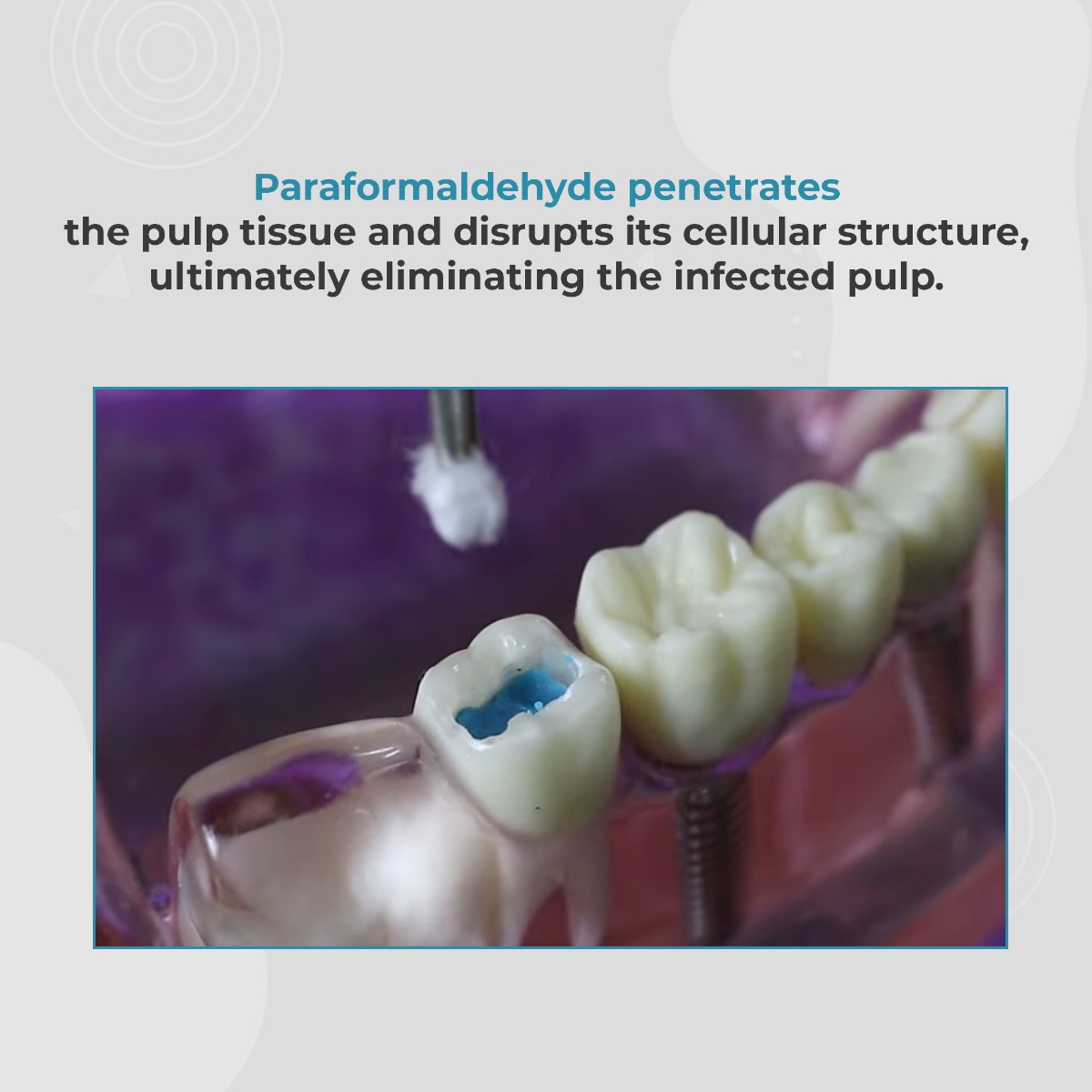Waldent Pulp Devitalizing Paste