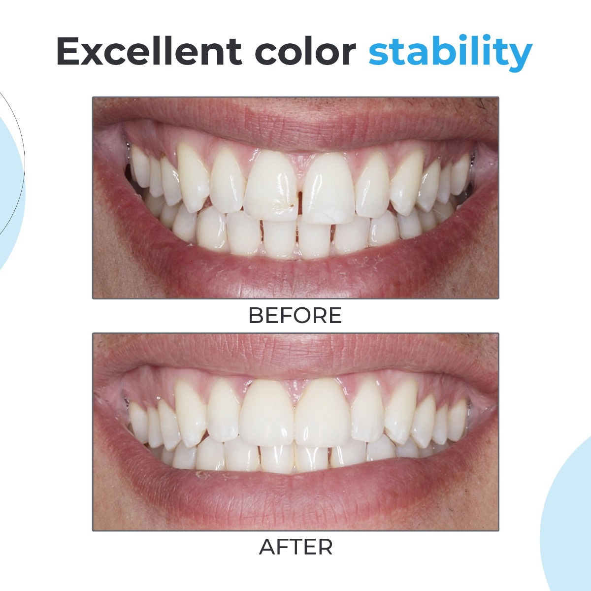 Waldent NanoFill Zirconium Composite Intro Kit