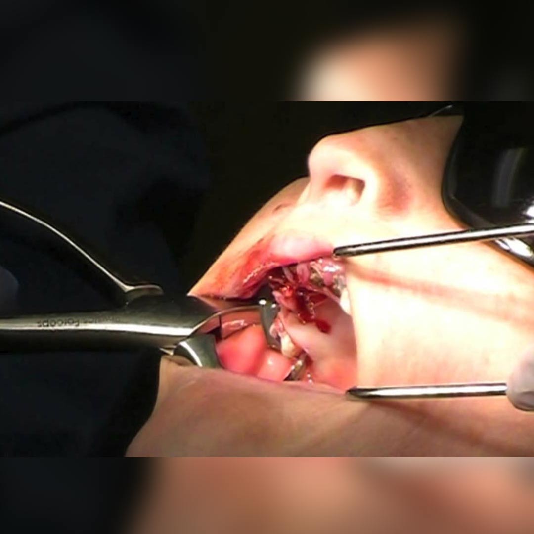 Waldent Physics Forceps - Pack of 1