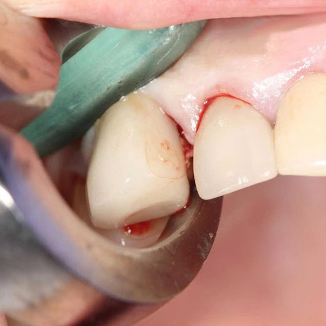 Waldent Physics Forceps - Pack of 1