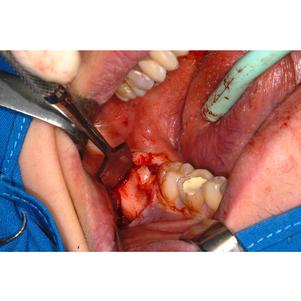 GDC Austin Cheek Retractor With Handle (TRA1)