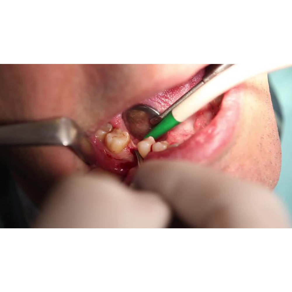 GDC Austin Cheek Retractor With Handle (TRA1)