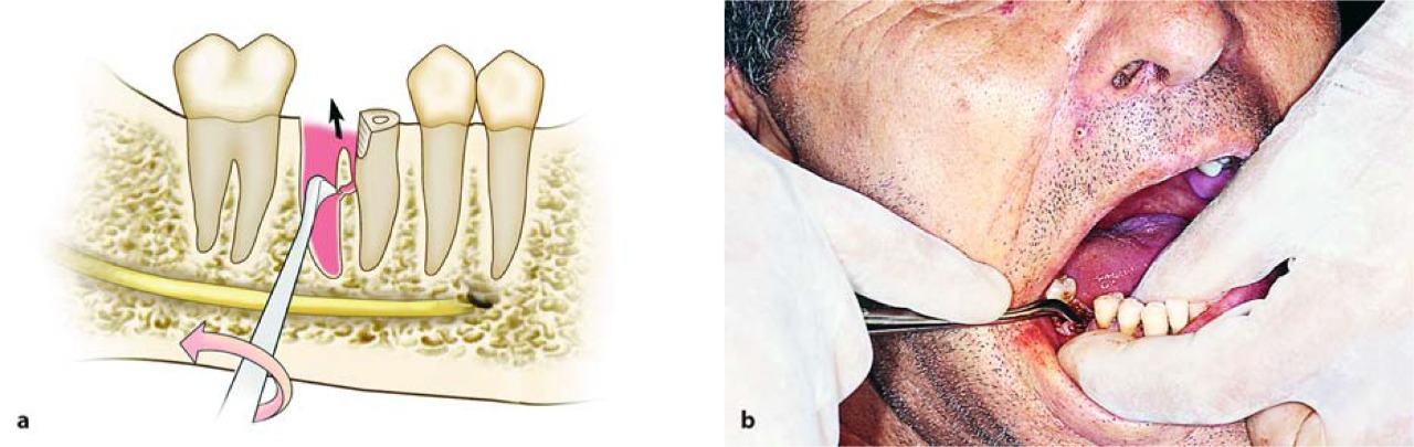 Waldent Root Elevator Instruments Kit Set of 11 K2/4