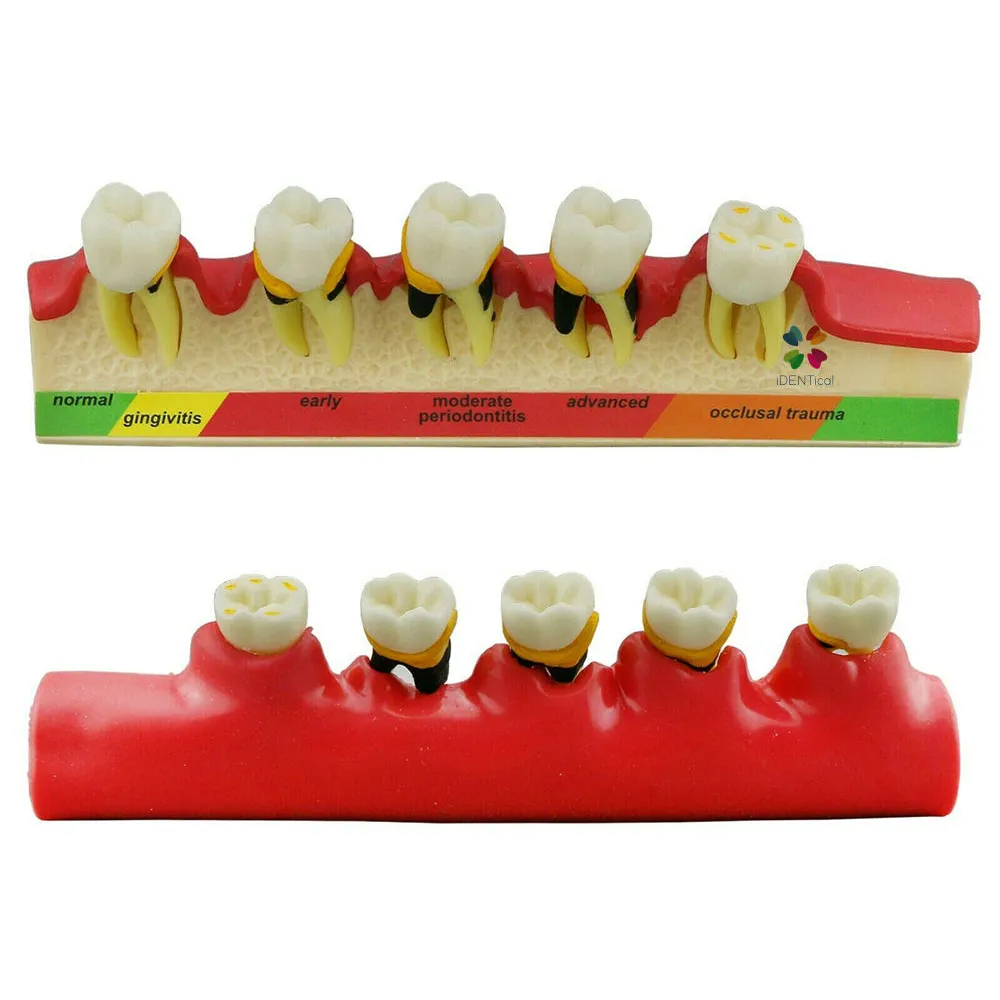 iDentical Stages Of Periodontitis Model - M4010