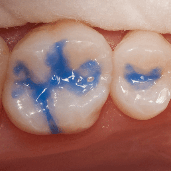 D-Tech Dental Etch Etching Gel (Dropper Pack)