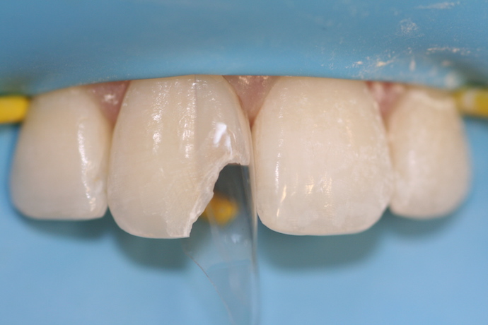 Restauro Conservativo Diretto Di Un Incisivo Centrale Fratturato - Foto 5