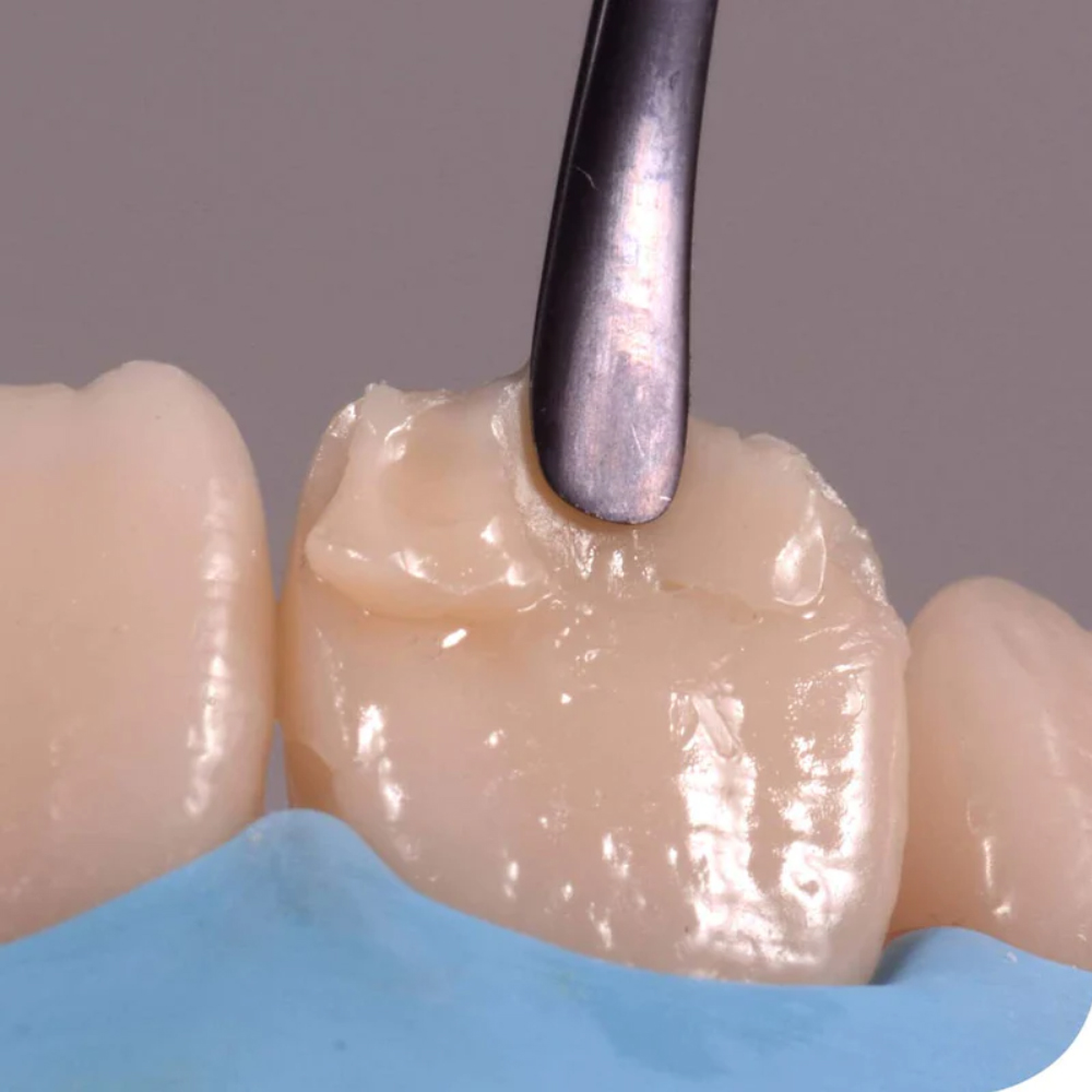 GDC Teflon Coated Composite Anterior Placing (Tncipcm)