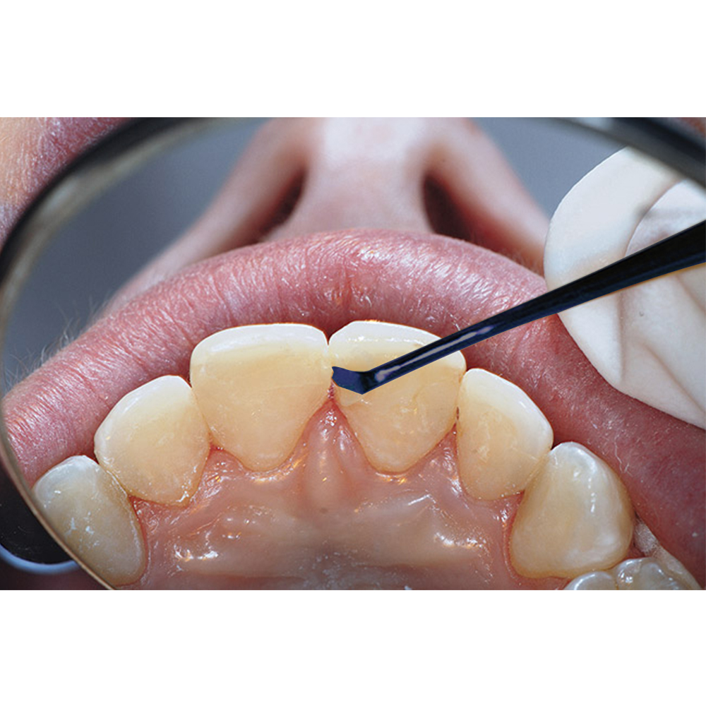 GDC Blue Titanium Coated Composite Instrument Anterior Set Of 5 Pcs (CIAPB5)