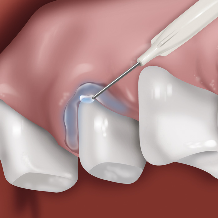 Ammdent Easy Stat Hemostatic Gel
