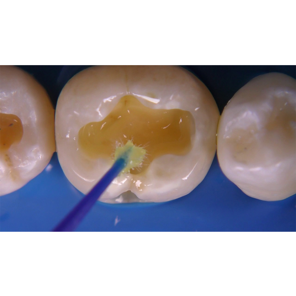 Prevest Denpro Crysta Dentin Conditioner (30021)