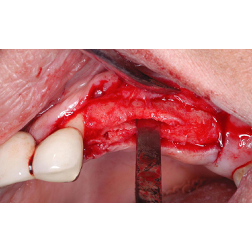 Waldent Chandler Bone Chisels