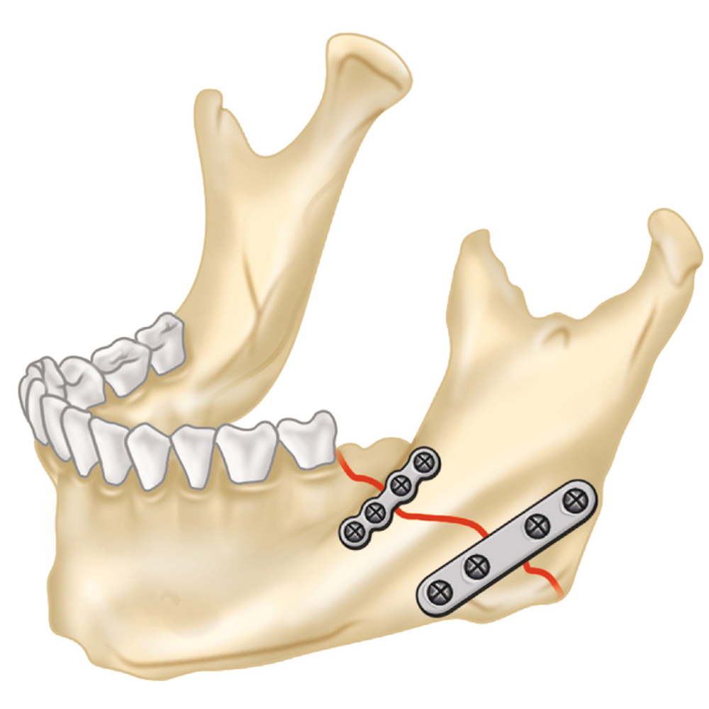 SK Surgicals SS Mini Bone Plates Continuous - 2.5mm