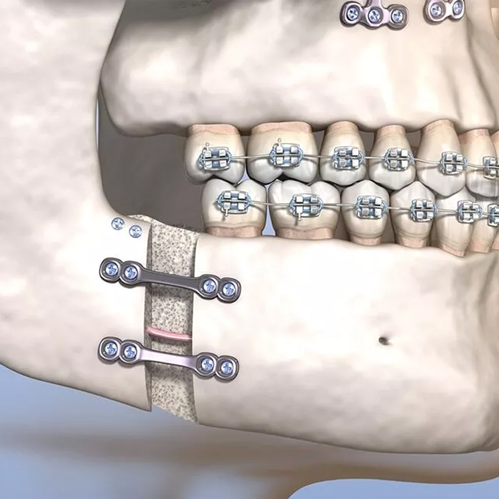 SK Surgicals Titanium Mini Bone Plates With Gap - 2.5mm