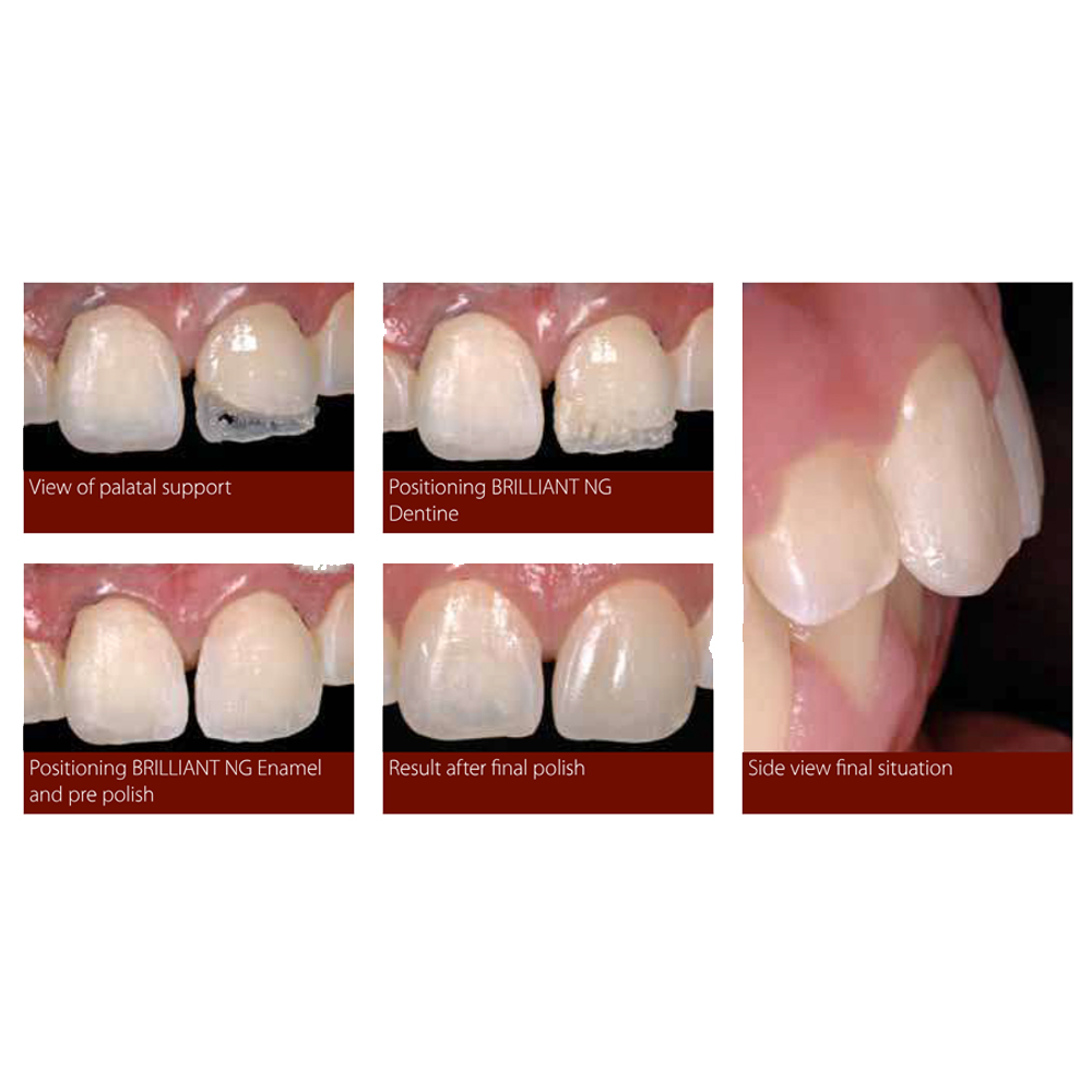 Coltene Whaledent Brilliant Ng Flow Syringes Refills