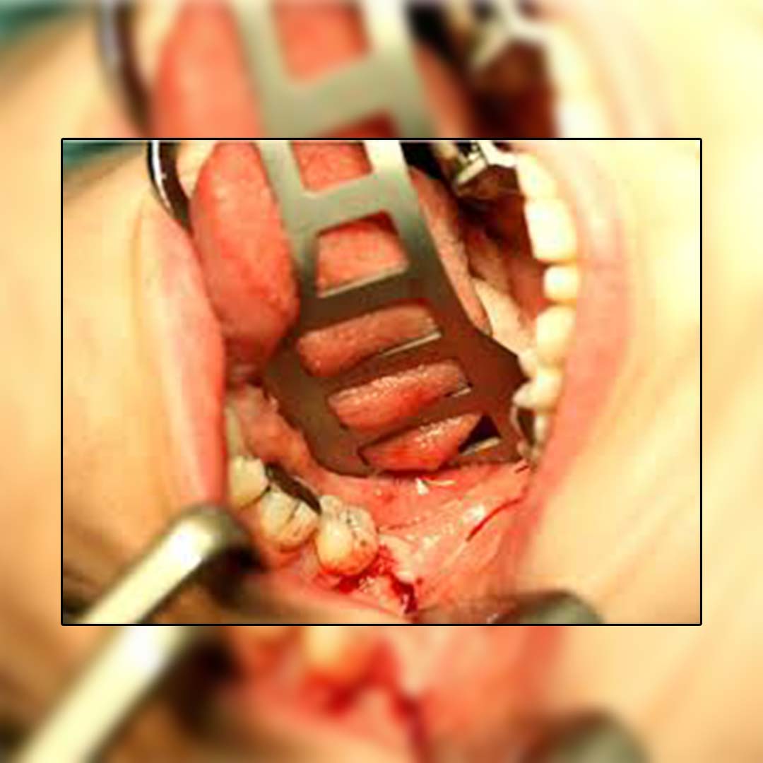 Waldent Bruening Retractor (8/113)