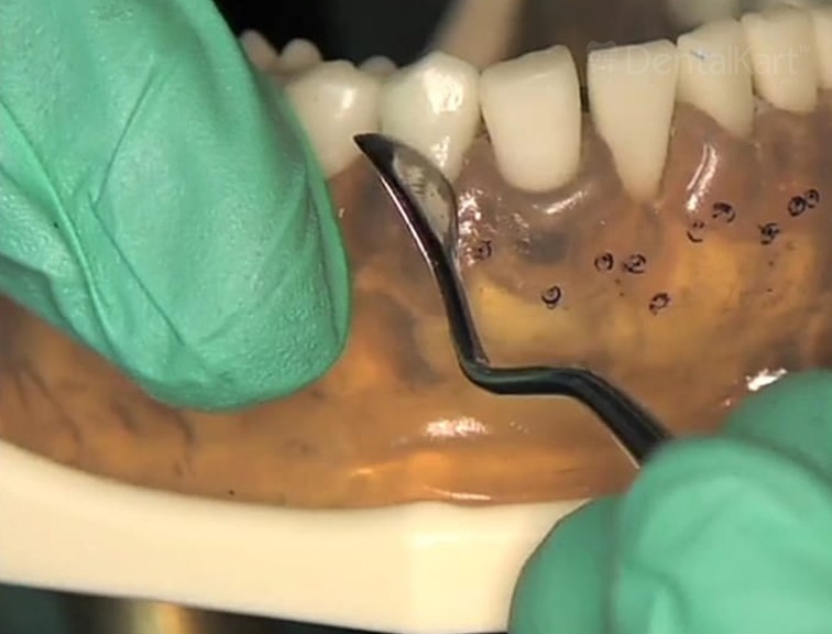 Waldent Periodontal Knives