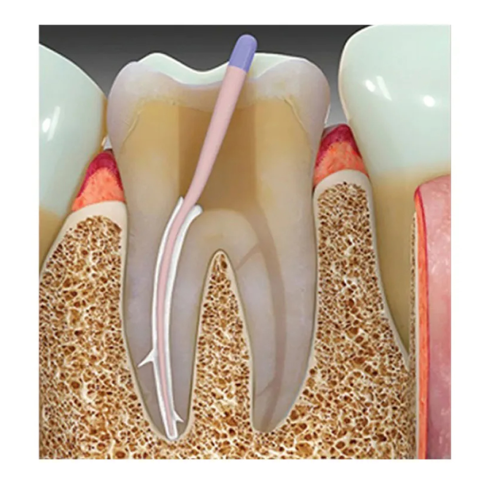 Prevest Denpro CalAPex Root Canal Sealer Manual Mix (40041-2)