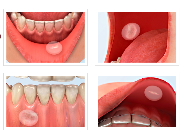 Curatick Oral Wound Dressing (Pack of 10) (Short Expiry 06-2026)