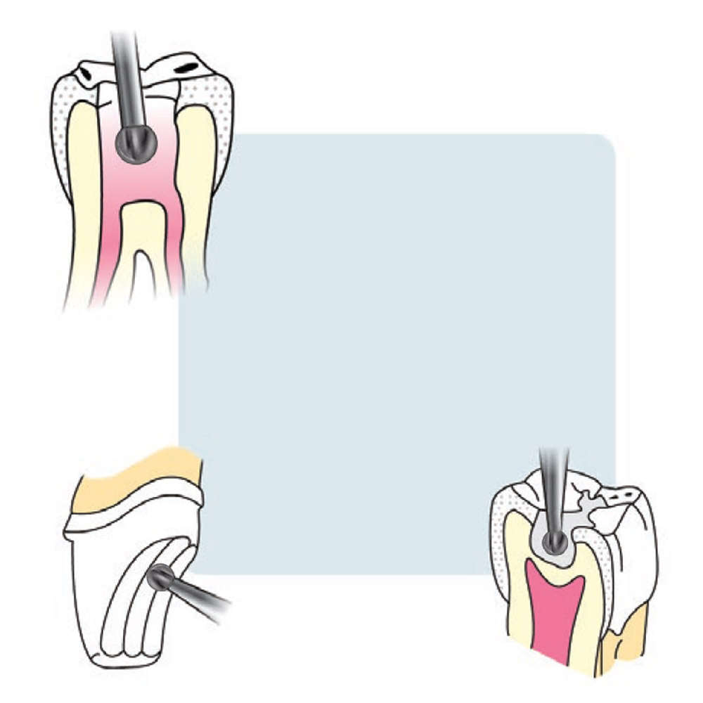 Frank Dental Carbide Bur C.1.018.HP -Pk/1 (Made in Germany)