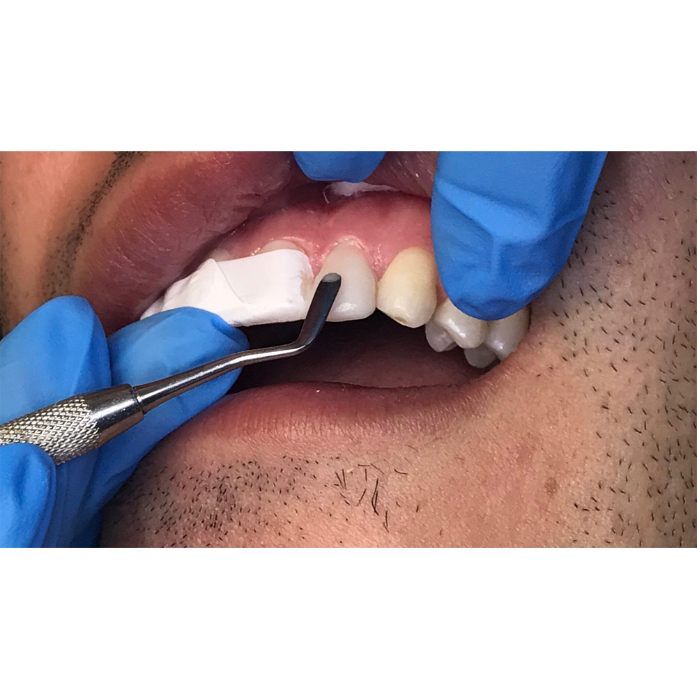 GDC Plastic Filling Instrument - 1 (PFI1)