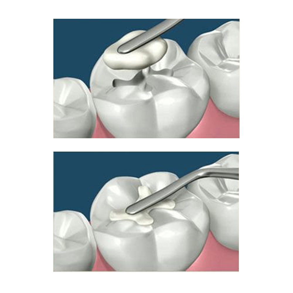 GDC Plastic Filling Instrument - 1 (PFI1)