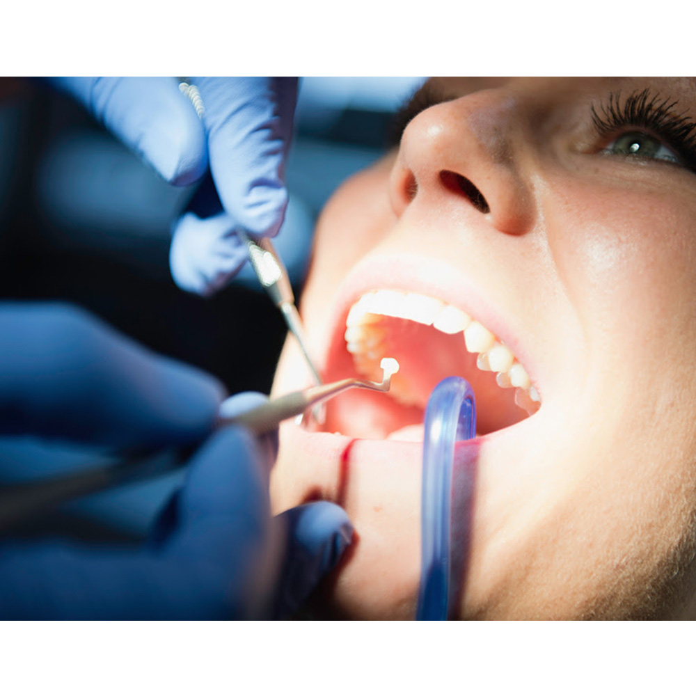 GDC Plastic Filling Instrument - 3 (PF21)