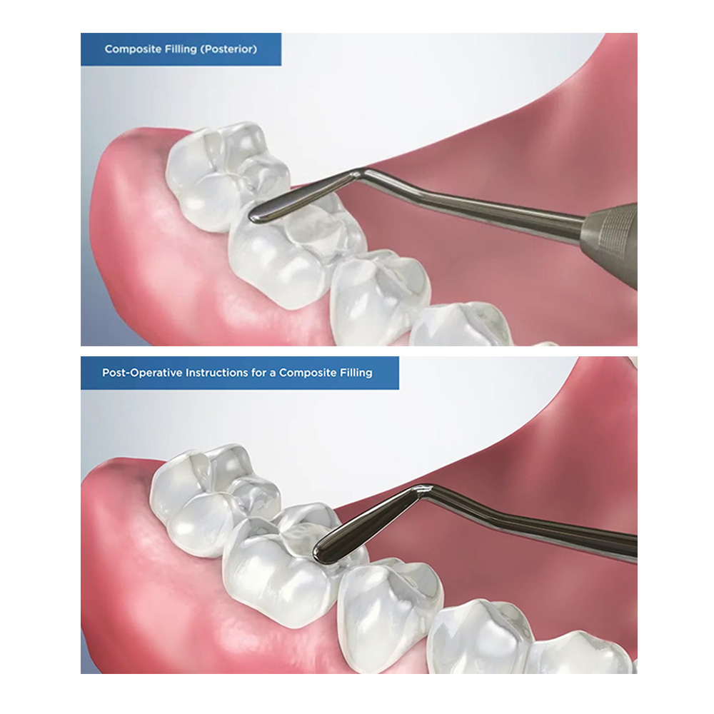 GDC Plastic Filling Instrument - 3 (PFGFT2)