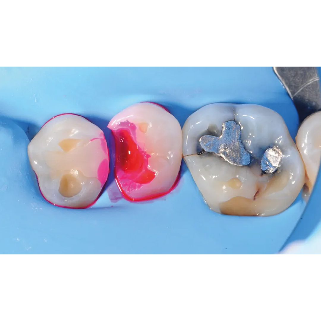 Kuraray Caries Detector