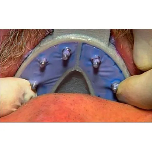 Cotisen Implant Impression Trays Set 