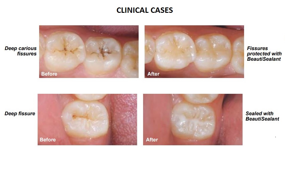 Shofu BeautiSealant Pit & Fissure Sealant