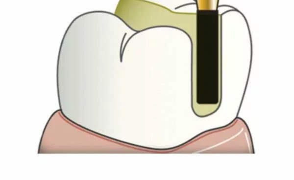 Frank Dental Cylinder Round Edge Diamond Burs SRS Series (Extra Fine)