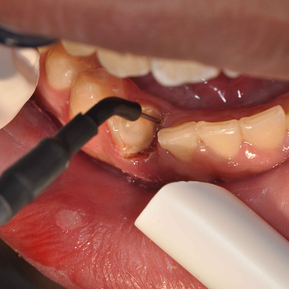 Younique R.F. Smart Cautery 