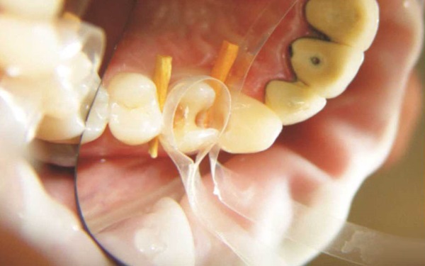 Tor Vm Transparent Contoured Matrices for Premolars & Molars
