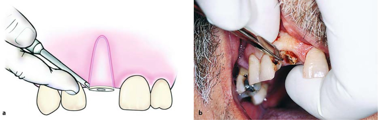 Waldent Root Elevators Premium Set of 11 (K2/2)