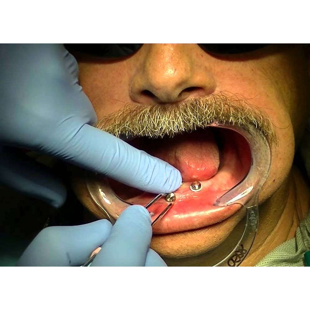 Xcem Denture Locator Abutment Cap 3.5mm (XDLC -3.5)