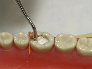 GI Dental Cement Carrier