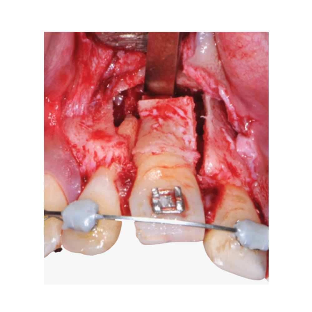 GDC Bone Chisel Gardner (4mm) (CG2)