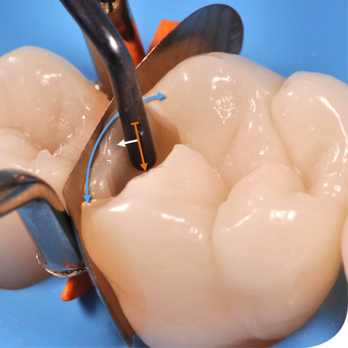 GDC Filling Instruments S/10 Ring handle Instruments Kit (FIWC10)