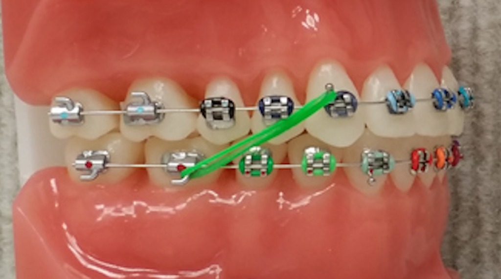 Captain Ortho Colour Elastics
