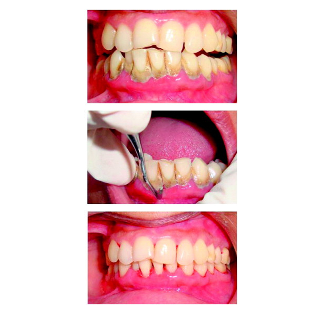 Waldent Columbia Curettes