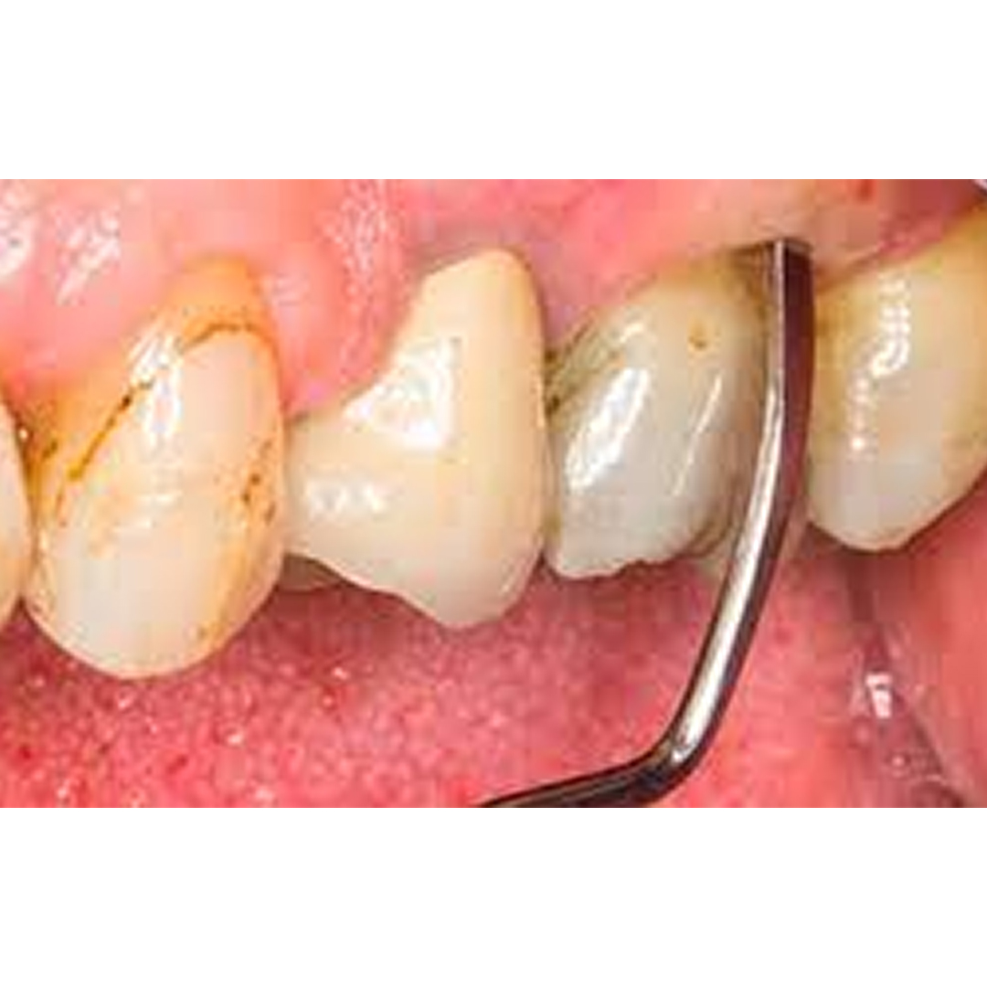 GDC Columbia Curettes 4r/4l Posterior Application #6 (Sc4r/4l)