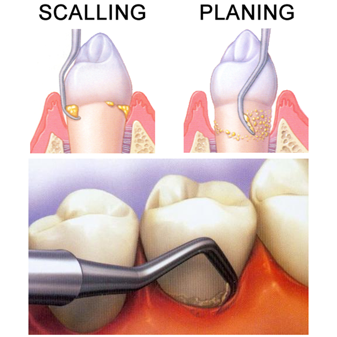 GDC Columbia Curettes 4r/4l Posterior Application #3 (Sc4r/4l)