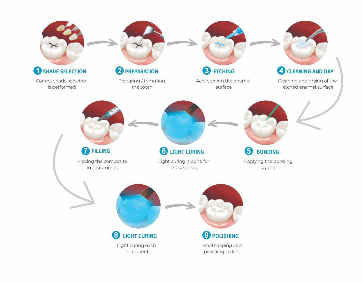 DentGist NanoCom Composite Kit 