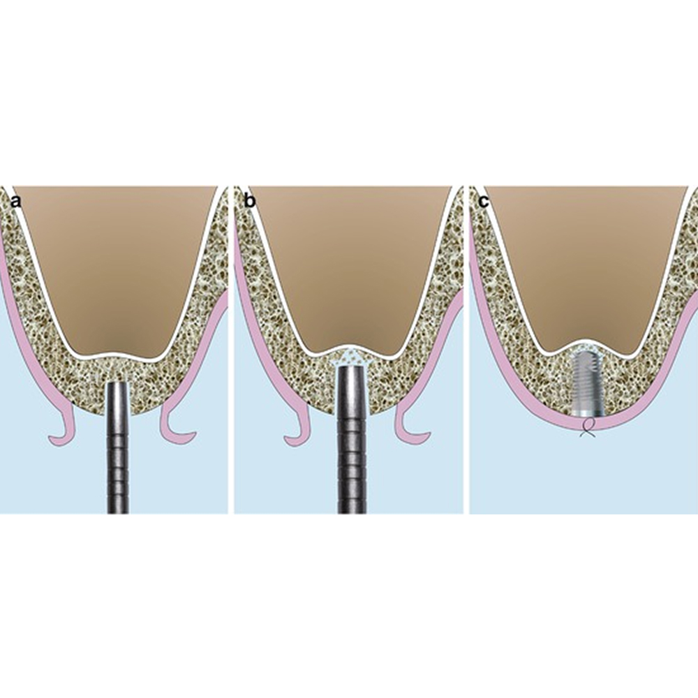 GDC Osteotomes Concave - Angulated (Ostmsh27a)