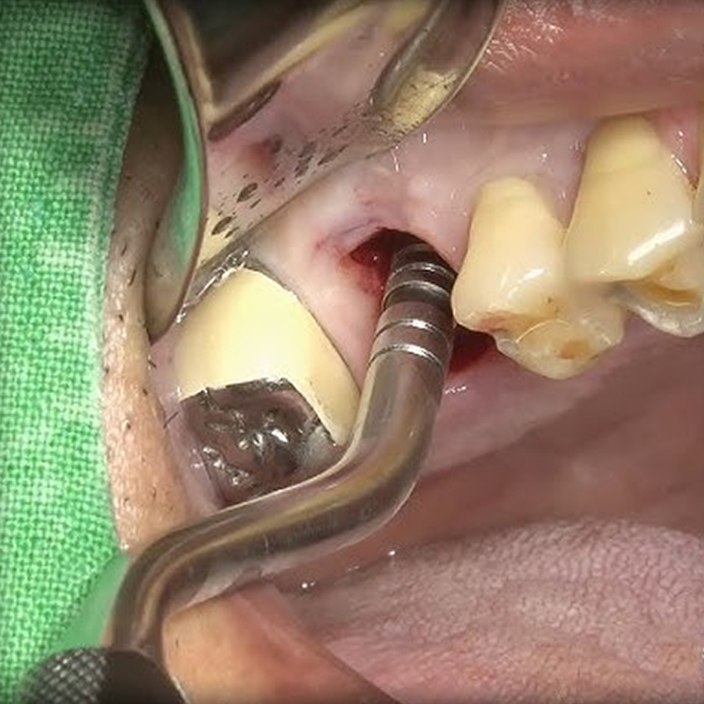 GDC Osteotomes Concave - Angulated (Ostmsh50a)