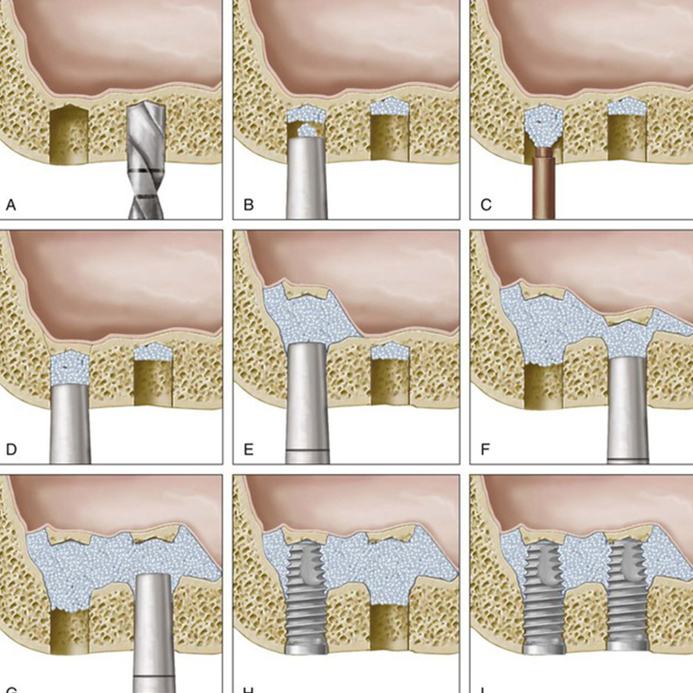GDC Osteotomes Convex - Angulated (Ostmsp42a)