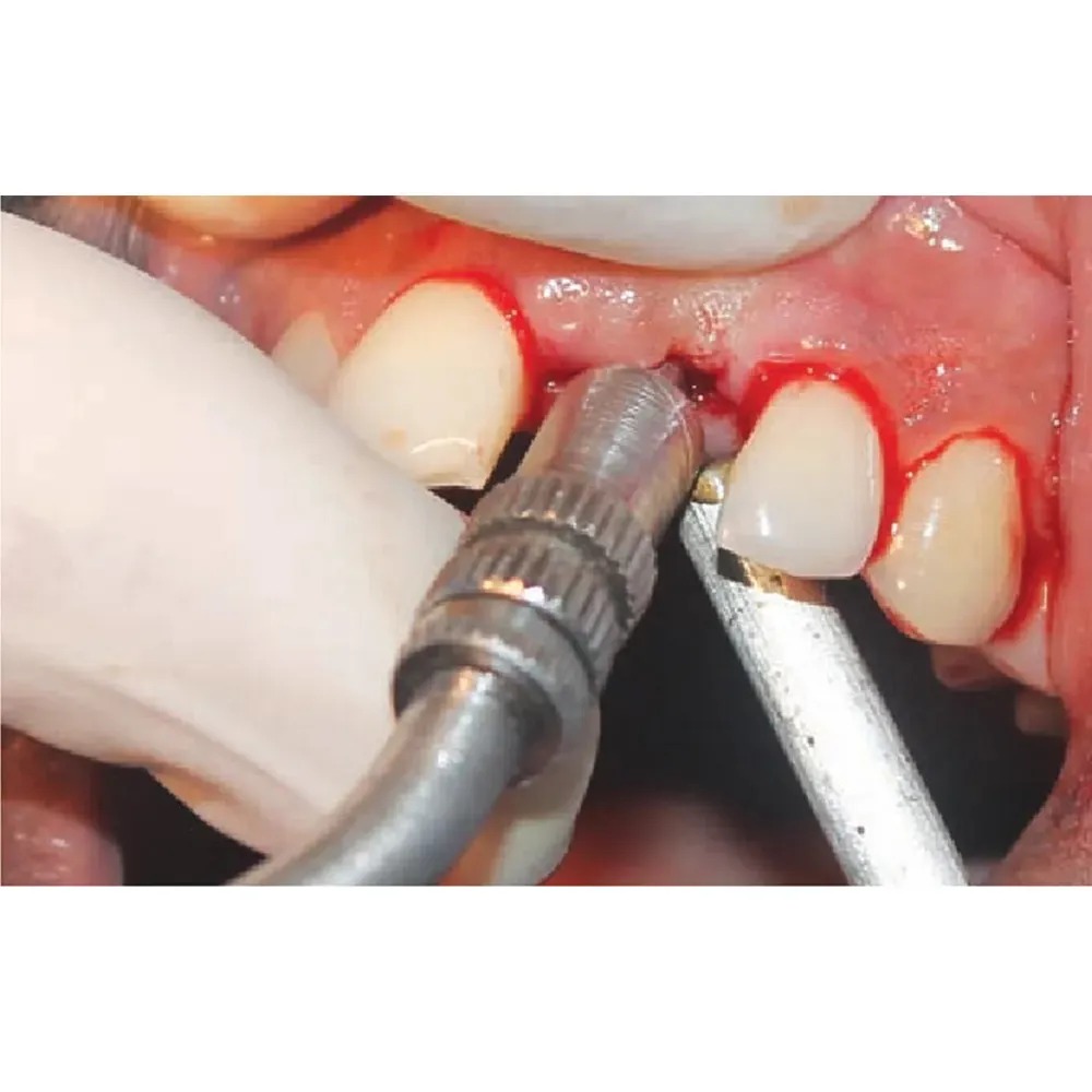 Julldent Osteotomes Convex For Expansion/Condensation Straight Set Of 5