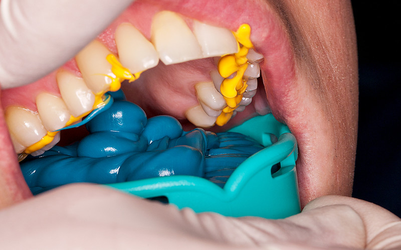 Prevest Denpro Accusil Combo Kit (70004-1)